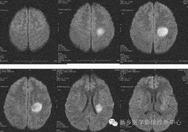 【读书笔记】脱髓鞘假瘤，一个有特征性的疾病
