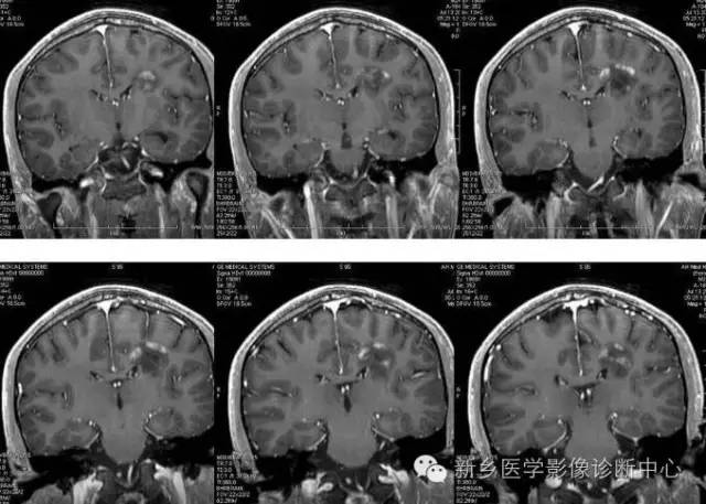 【读书笔记】脱髓鞘假瘤，一个有特征性的疾病