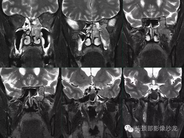【病例】左鼻低分化鳞癌1例CT及MR影像表现 【病例】左鼻低分化鳞癌1例CT及MR影像表现