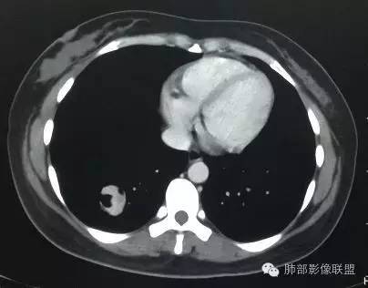 【病例】一个诡异的空洞——炎性肌纤维母细胞瘤1例影像诊断分析