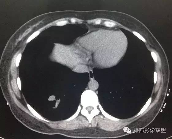 【病例】一个诡异的空洞——炎性肌纤维母细胞瘤1例影像诊断分析