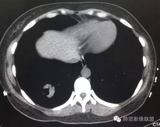 【病例】一个诡异的空洞——炎性肌纤维母细胞瘤1例影像诊断分析