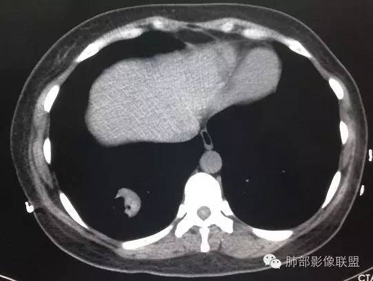 【病例】一个诡异的空洞——炎性肌纤维母细胞瘤1例影像诊断分析