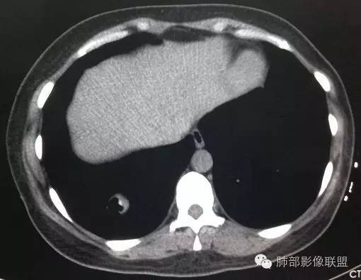 【病例】一个诡异的空洞——炎性肌纤维母细胞瘤1例影像诊断分析