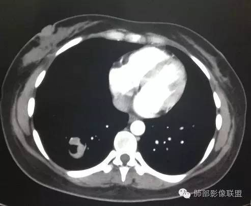 【病例】一个诡异的空洞——炎性肌纤维母细胞瘤1例影像诊断分析