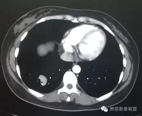 【病例】一个诡异的空洞——炎性肌纤维母细胞瘤1例影像诊断分析