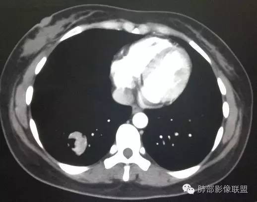 【病例】一个诡异的空洞——炎性肌纤维母细胞瘤1例影像诊断分析