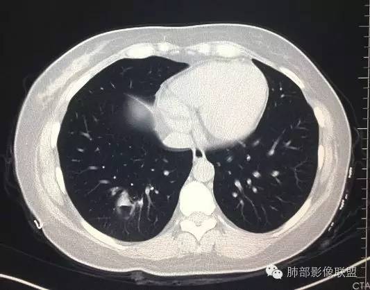【病例】一个诡异的空洞——炎性肌纤维母细胞瘤1例影像诊断分析