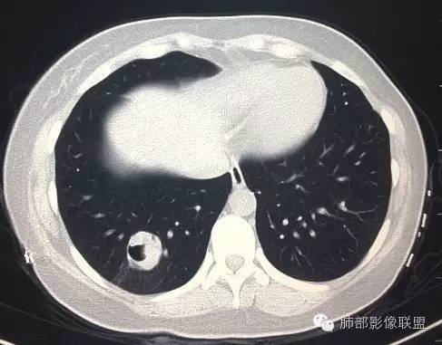 【病例】一个诡异的空洞——炎性肌纤维母细胞瘤1例影像诊断分析