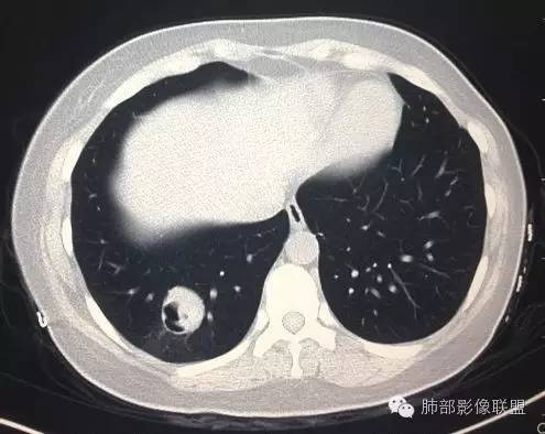 【病例】一个诡异的空洞——炎性肌纤维母细胞瘤1例影像诊断分析