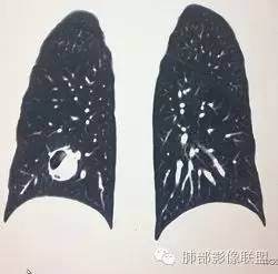 【病例】一个诡异的空洞——炎性肌纤维母细胞瘤1例影像诊断分析