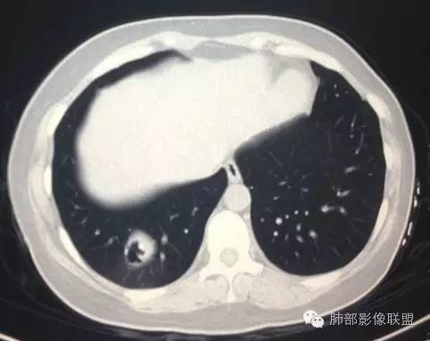 【病例】一个诡异的空洞——炎性肌纤维母细胞瘤1例影像诊断分析