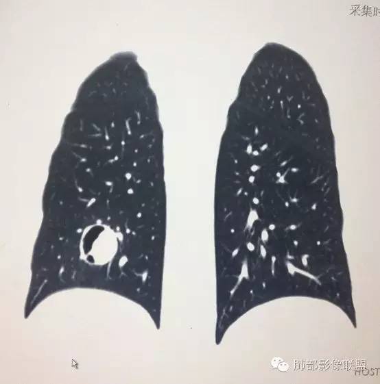 【病例】一个诡异的空洞——炎性肌纤维母细胞瘤1例影像诊断分析