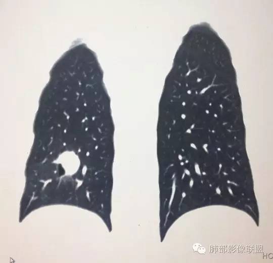 【病例】一个诡异的空洞——炎性肌纤维母细胞瘤1例影像诊断分析