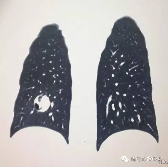 【病例】一个诡异的空洞——炎性肌纤维母细胞瘤1例影像诊断分析