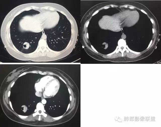 【病例】一个诡异的空洞——炎性肌纤维母细胞瘤1例影像诊断分析