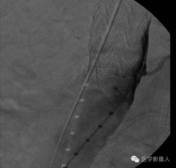内漏分型及CT诊断 内漏分型及CT诊断