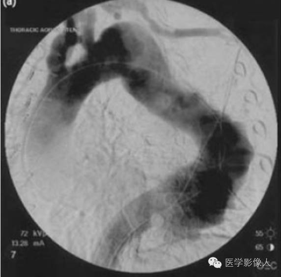 内漏分型及CT诊断 内漏分型及CT诊断