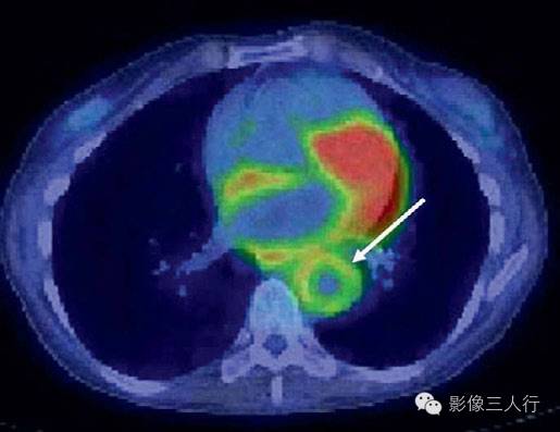 多发性大动脉炎