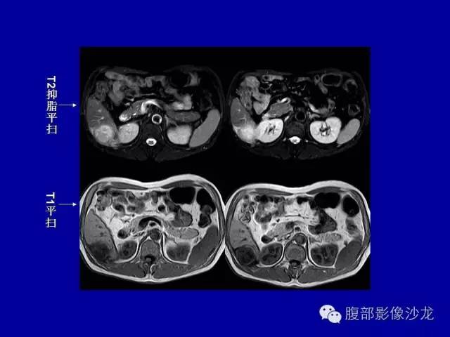 【病例】右侧膈肌透明细胞腺癌1例MR影像表现 【病例】右侧膈肌透明细胞腺癌1例MR影像表现