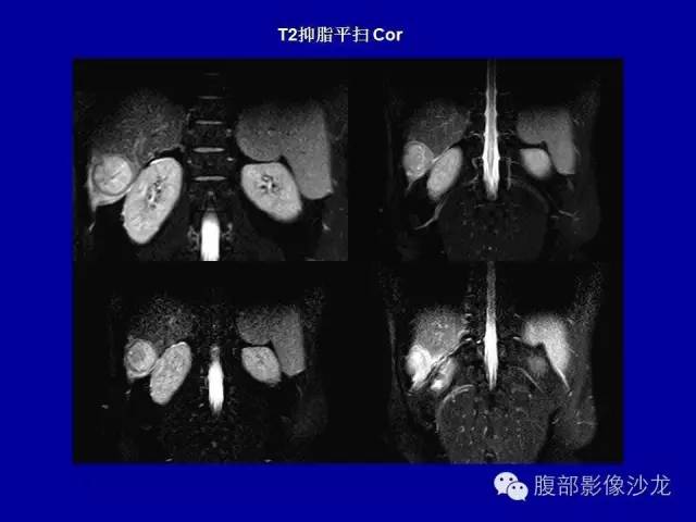 【病例】右侧膈肌透明细胞腺癌1例MR影像表现 【病例】右侧膈肌透明细胞腺癌1例MR影像表现