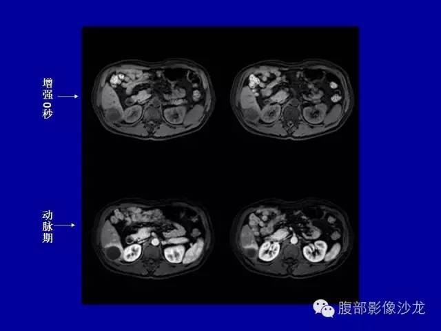 【病例】右侧膈肌透明细胞腺癌1例MR影像表现 【病例】右侧膈肌透明细胞腺癌1例MR影像表现