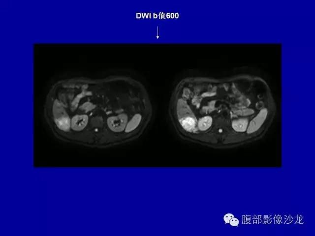【病例】右侧膈肌透明细胞腺癌1例MR影像表现 【病例】右侧膈肌透明细胞腺癌1例MR影像表现