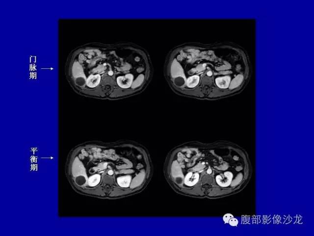 【病例】右侧膈肌透明细胞腺癌1例MR影像表现 【病例】右侧膈肌透明细胞腺癌1例MR影像表现