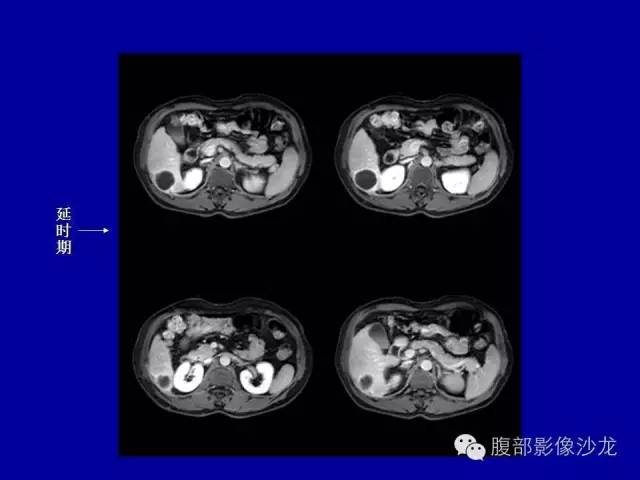 【病例】右侧膈肌透明细胞腺癌1例MR影像表现 【病例】右侧膈肌透明细胞腺癌1例MR影像表现