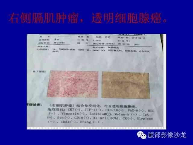 【病例】右侧膈肌透明细胞腺癌1例MR影像表现 【病例】右侧膈肌透明细胞腺癌1例MR影像表现