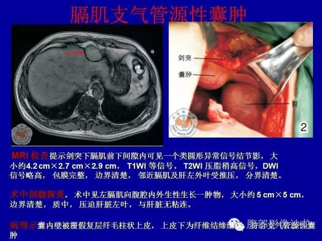【病例】右侧膈肌透明细胞腺癌1例MR影像表现 【病例】右侧膈肌透明细胞腺癌1例MR影像表现