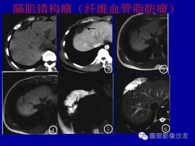 【病例】右侧膈肌透明细胞腺癌1例MR影像表现 【病例】右侧膈肌透明细胞腺癌1例MR影像表现