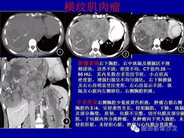 【病例】右侧膈肌透明细胞腺癌1例MR影像表现 【病例】右侧膈肌透明细胞腺癌1例MR影像表现