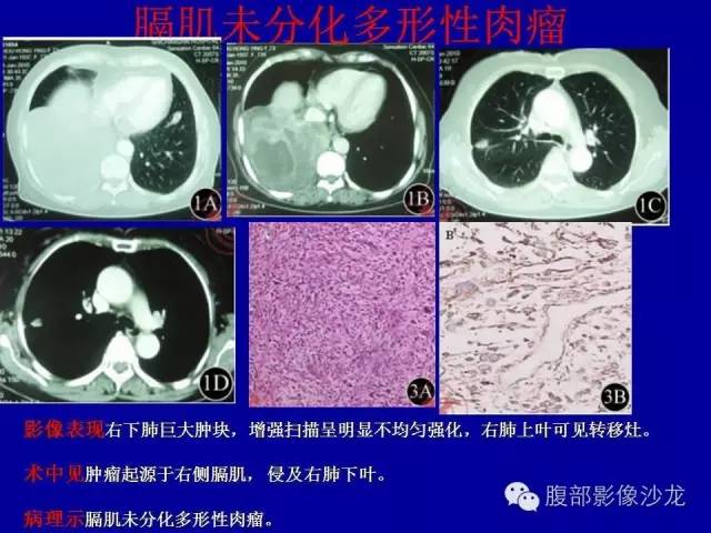 【病例】右侧膈肌透明细胞腺癌1例MR影像表现 【病例】右侧膈肌透明细胞腺癌1例MR影像表现