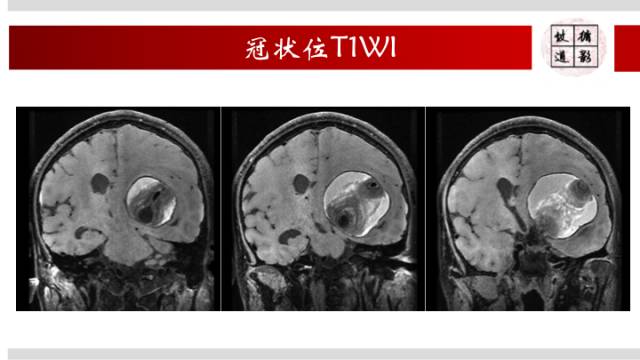 【病例】颅内巨大蛇形动脉瘤1例MR影像表现