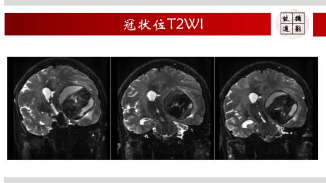 【病例】颅内巨大蛇形动脉瘤1例MR影像表现