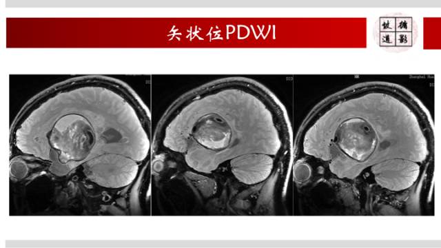 【病例】颅内巨大蛇形动脉瘤1例MR影像表现