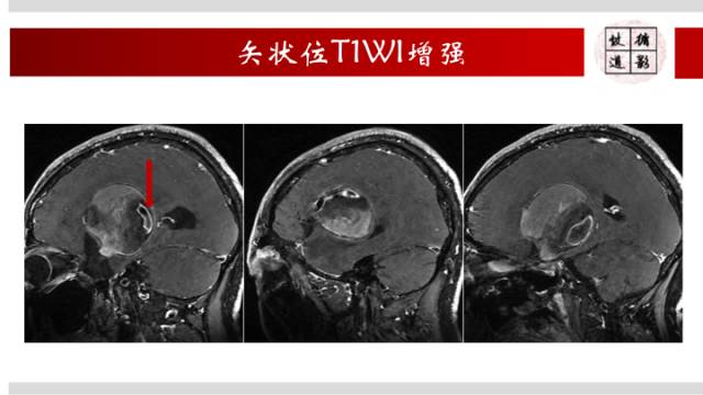 【病例】颅内巨大蛇形动脉瘤1例MR影像表现