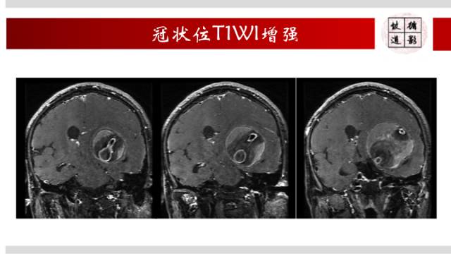 【病例】颅内巨大蛇形动脉瘤1例MR影像表现