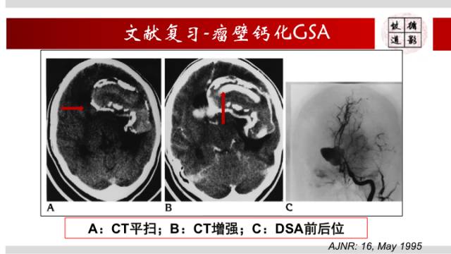 【病例】颅内巨大蛇形动脉瘤1例MR影像表现