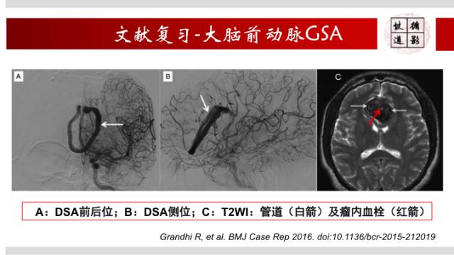 【病例】颅内巨大蛇形动脉瘤1例MR影像表现