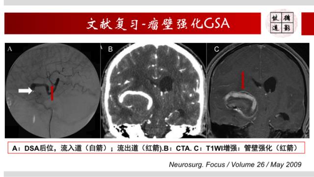 【病例】颅内巨大蛇形动脉瘤1例MR影像表现