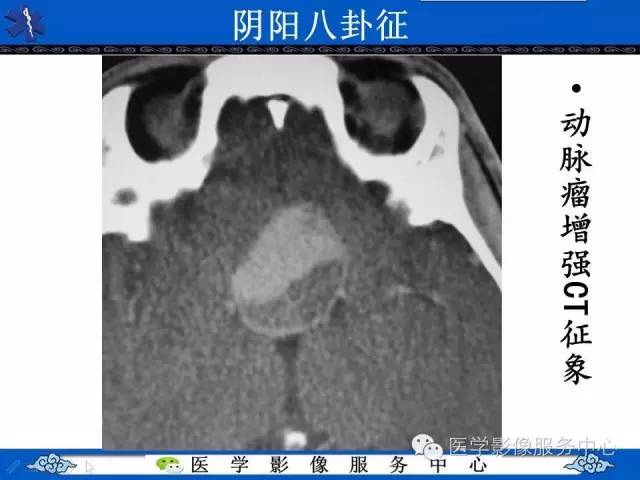 【影像征象】阴阳八卦征