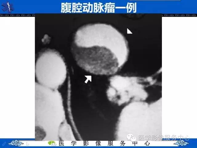【影像征象】阴阳八卦征