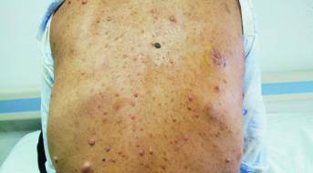 【病例】误诊为右上纵隔肿瘤的胸腔内脊膜膨出症1例 【病例】误诊为右上纵隔肿瘤的胸腔内脊膜膨出症1例