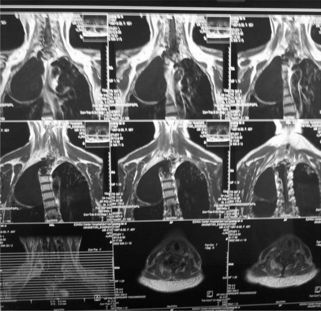 【病例】误诊为右上纵隔肿瘤的胸腔内脊膜膨出症1例 【病例】误诊为右上纵隔肿瘤的胸腔内脊膜膨出症1例