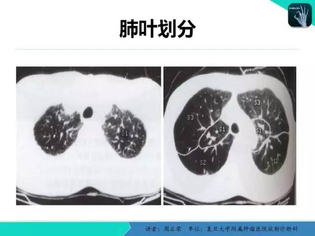 【PPT】肺癌的CT诊断