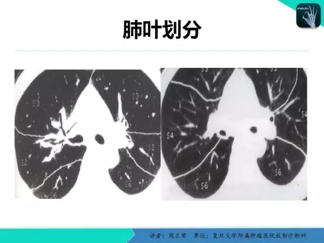 【PPT】肺癌的CT诊断