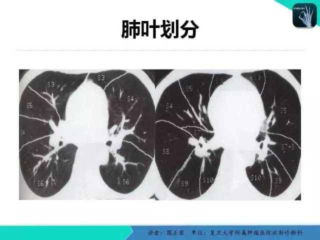 【PPT】肺癌的CT诊断