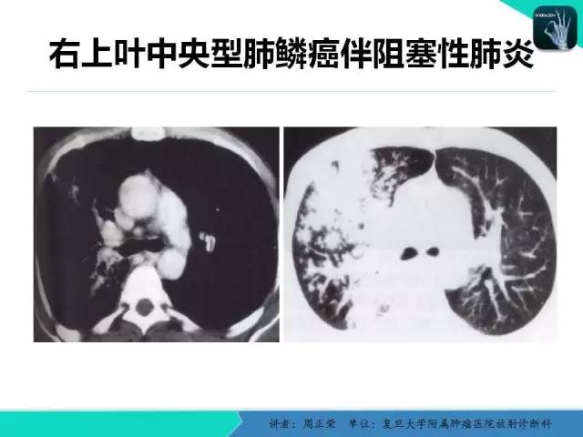 【PPT】肺癌的CT诊断